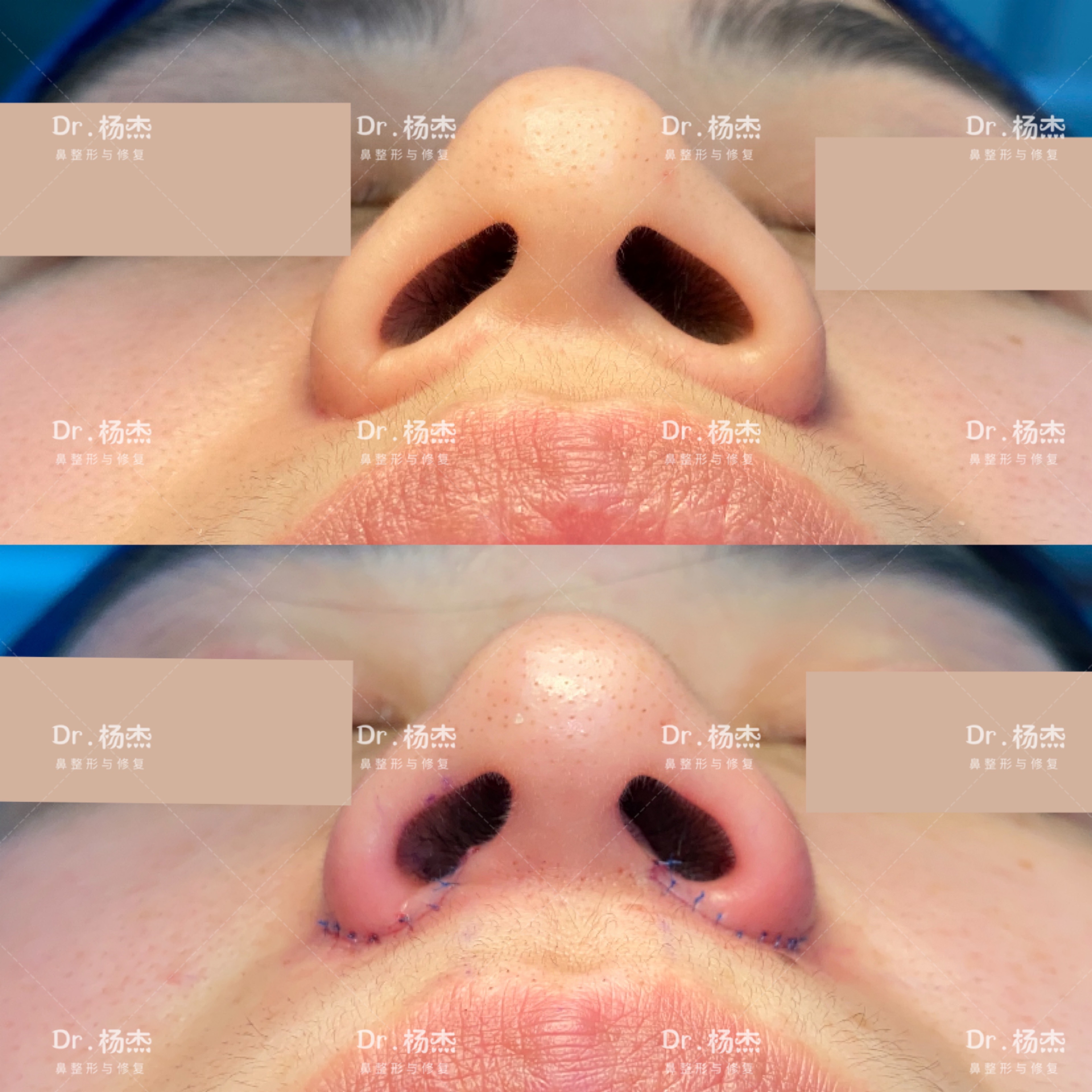 鼻翼内切缩小适合哪些人