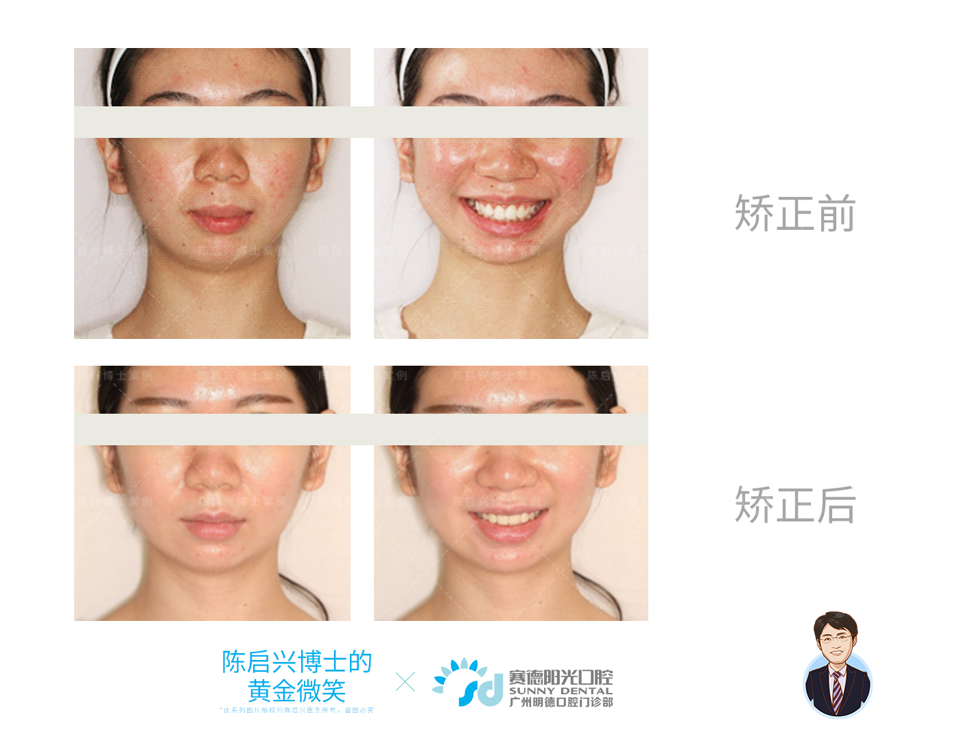 ii类骨性嘴突矫正