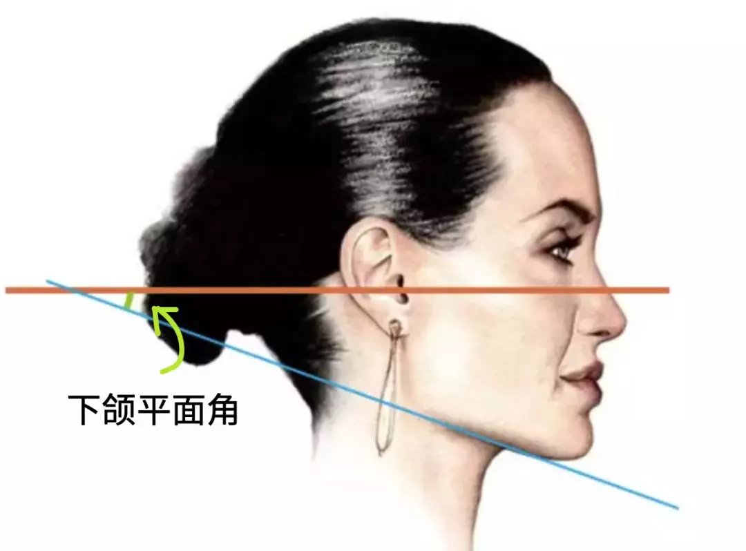 76 没有颏部(颏发育不足)