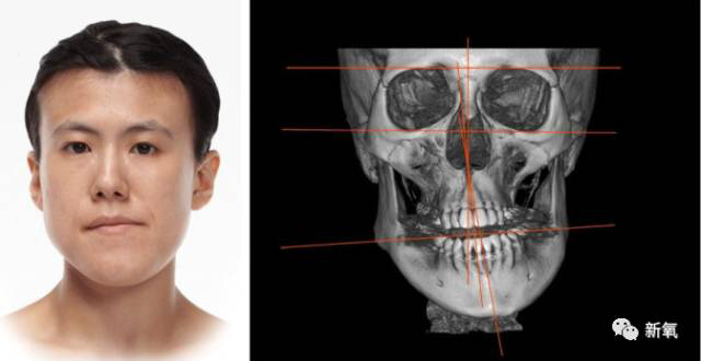林志颖老婆因为长得丑被嘲了十几年,如今歪脸整好了,嫩如18