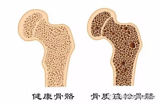 使用还有更多的副作用:血糖升高,血压升高,骨质疏松和免疫力的降低,易