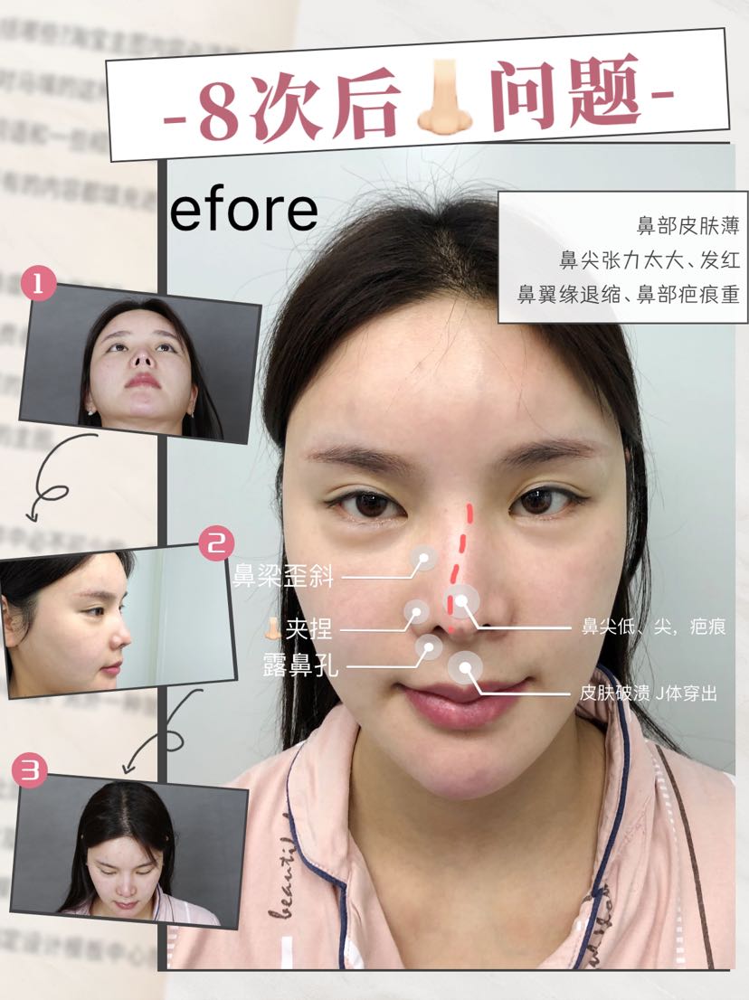 31566,【修复方案】鼻梁重新换假体调整肋软骨支架左侧耳屏软骨垫