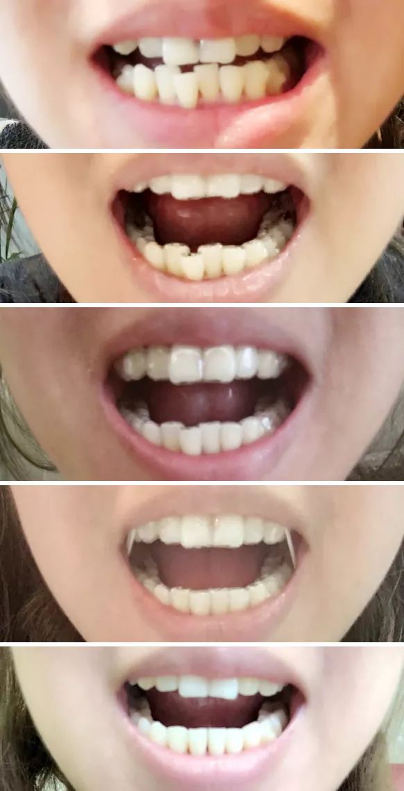 矫正前最担心的问题,一个是拔牙,二是无法接受满口钢丝影响日常形象