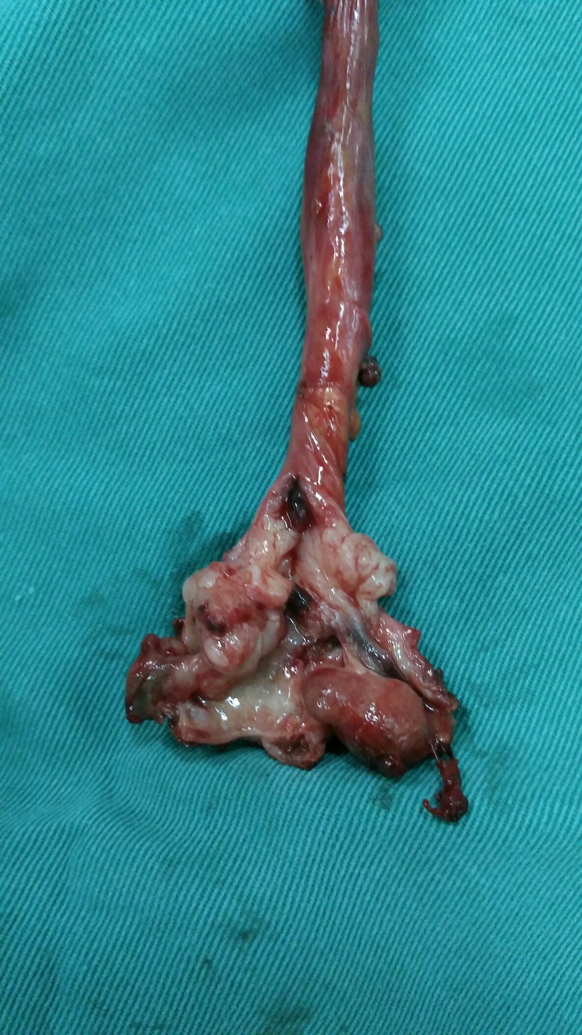 输尿管癌后腹腔镜根治性左肾左输尿管切除术2016年11月