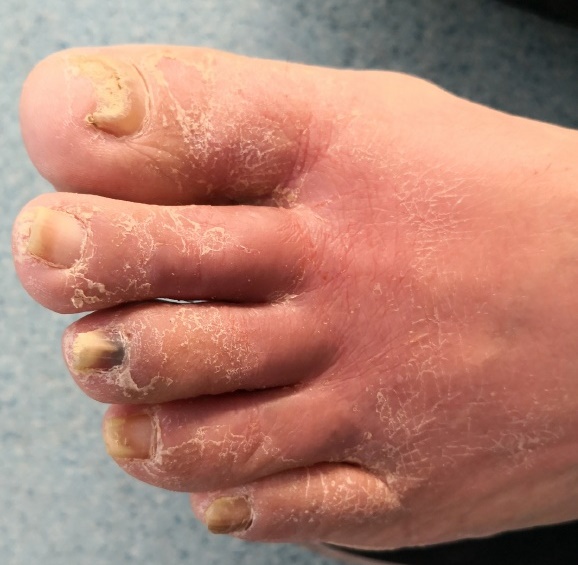 皮肤常常表现为环状红斑,下肢丹毒及荨麻疹样癣菌疹多见于足癣患者