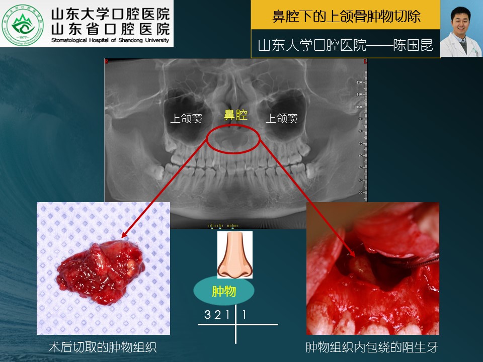 頜面外科手術系列1鼻腔下的上頜骨腫物