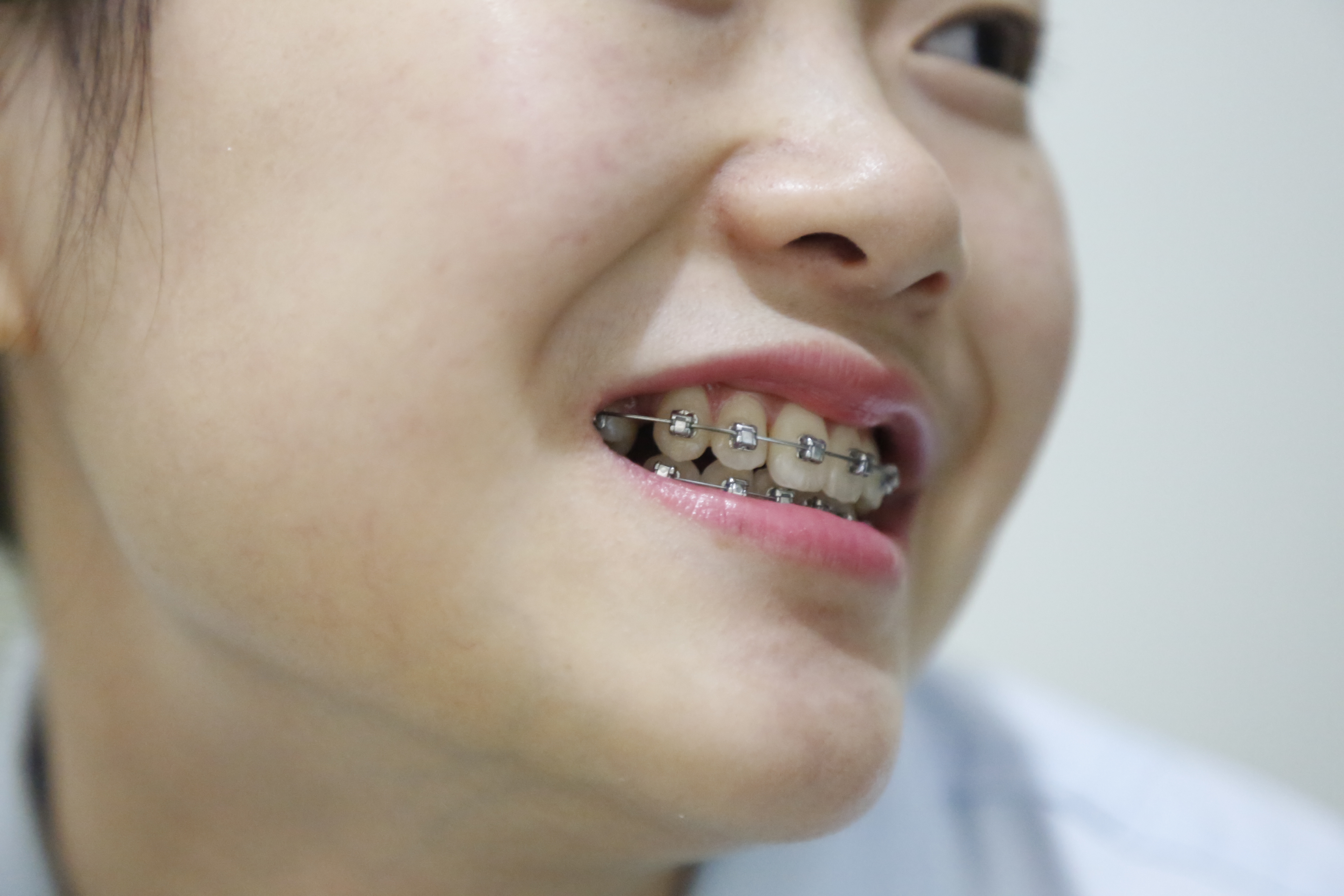 牙科医生任欢告诉你:多大年龄戴牙套比较合适!