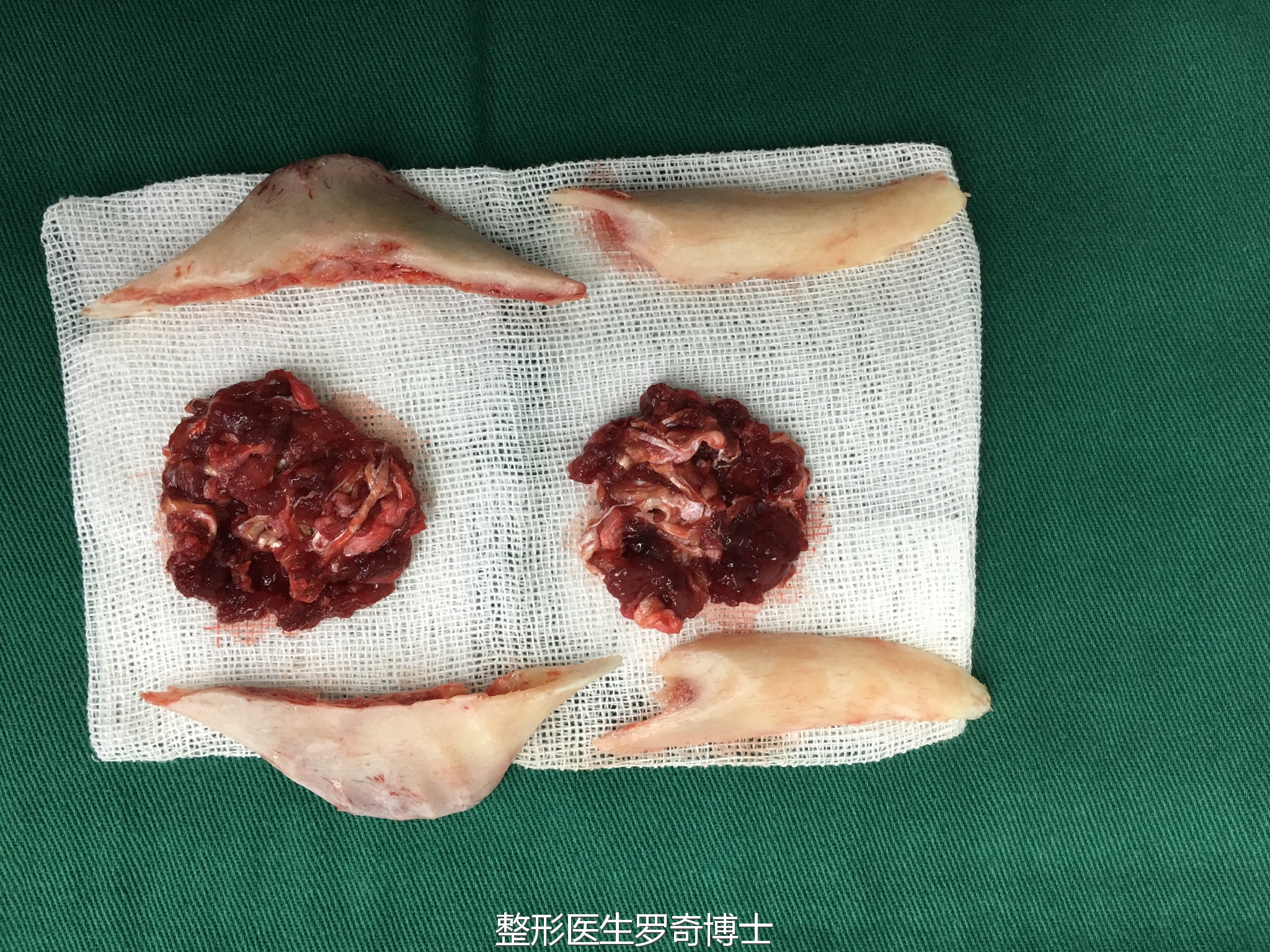 "颏侧截骨"——脸型点睛之笔