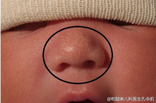 新生儿脓疱疹图片