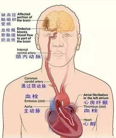 脑梗死位置图图片