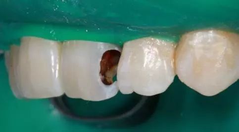 牙齿颜色不均匀有"白斑",这是开始脱矿了!-王云丁-爱问医生