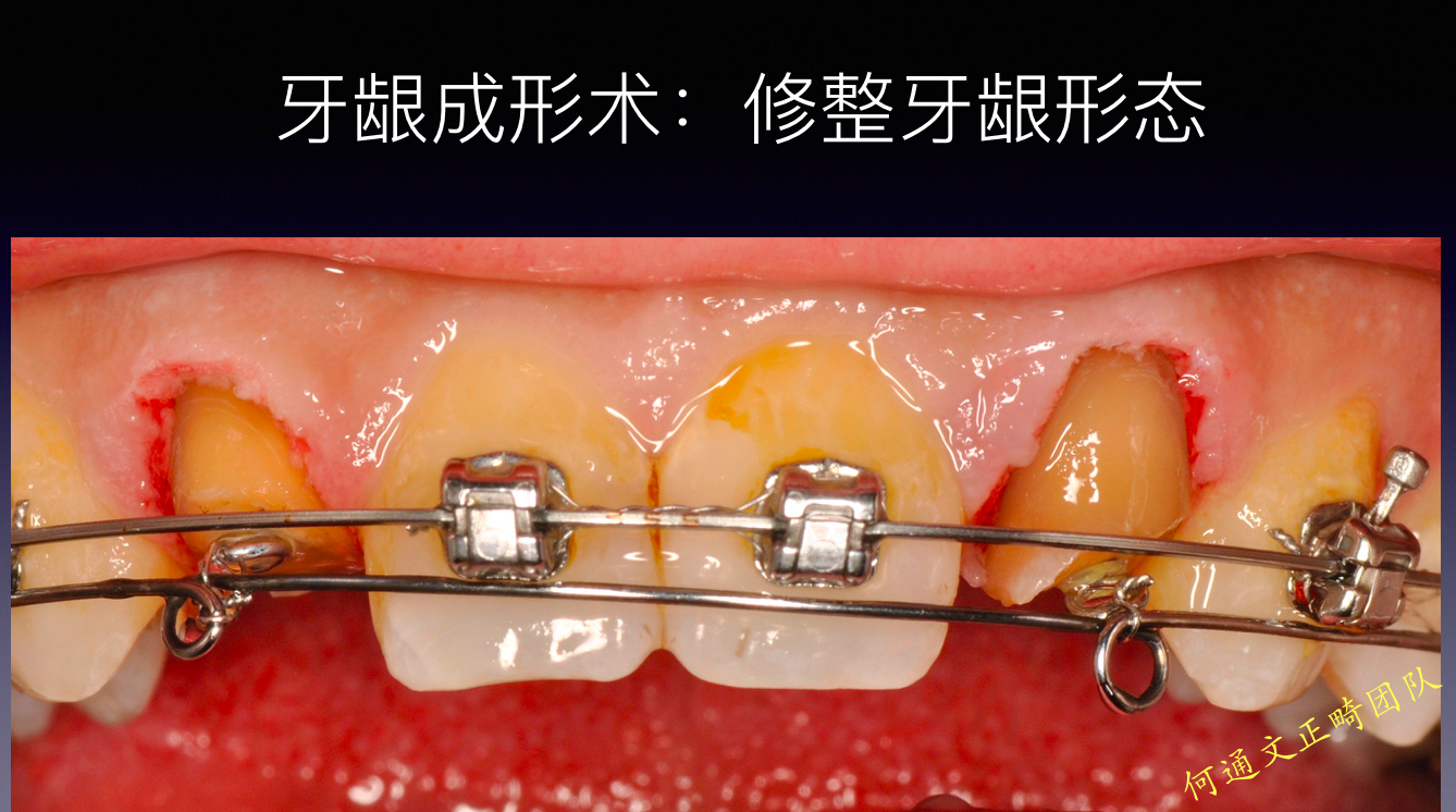 总结:12 22 残根位于龈缘下约3-4mm,如果不采用正畸牵引的方式将很难