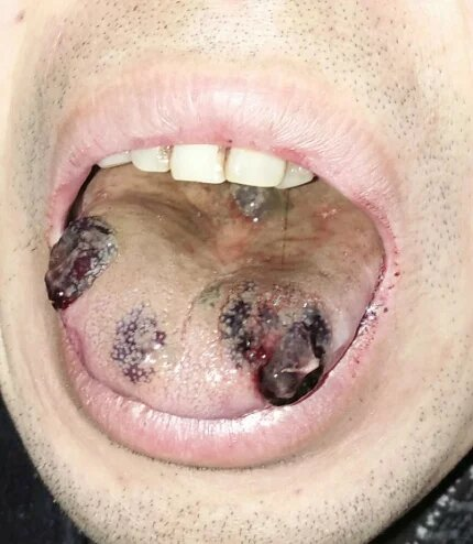 舌头火疮的症状图片图片