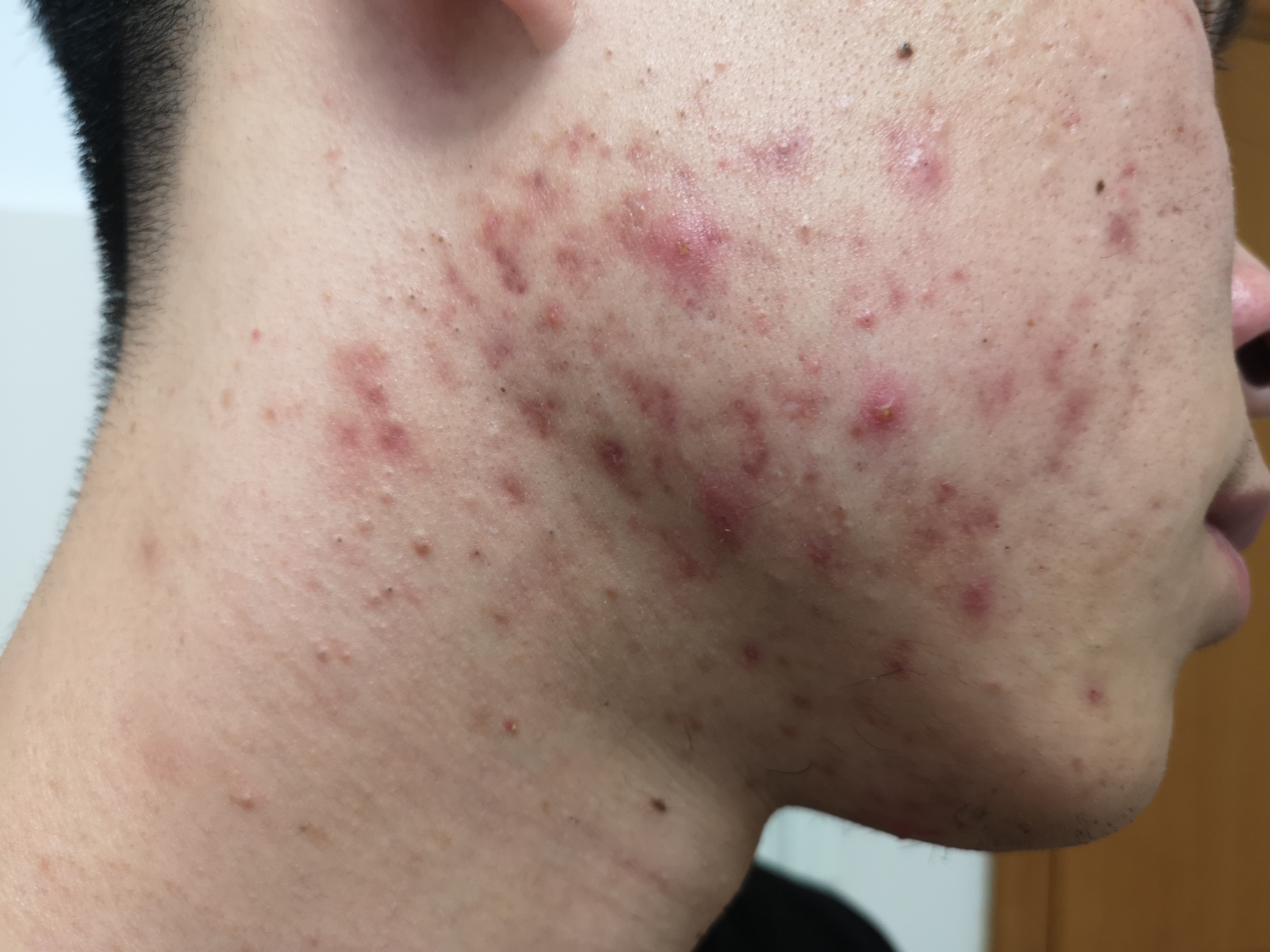 爆痘是怎么回事 痤疮