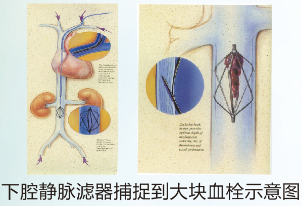 下肢静脉血栓脱落导致患者猝死