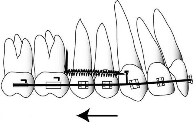 关于正畸拔牙,你应该知道这些!