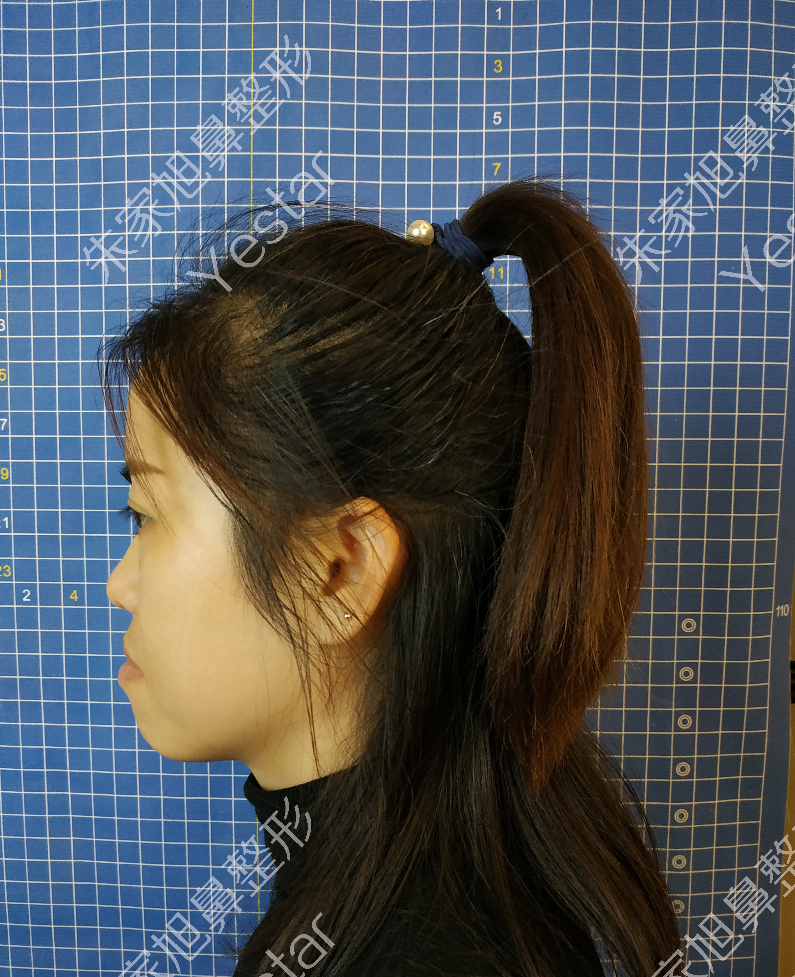 低鼻短鼻案例分享和术后恢复情况