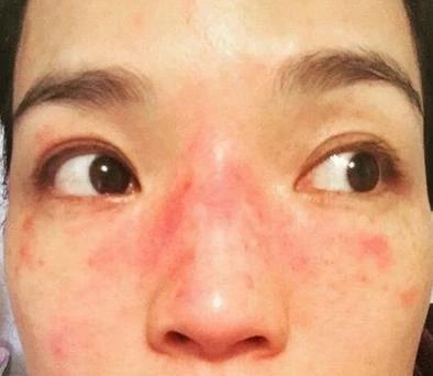 治疗以修复屏障为主,可选用低能量光子,水杨酸,射频,同时可以选用一些
