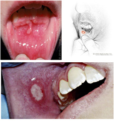 小儿口腔溃疡图片大全图片
