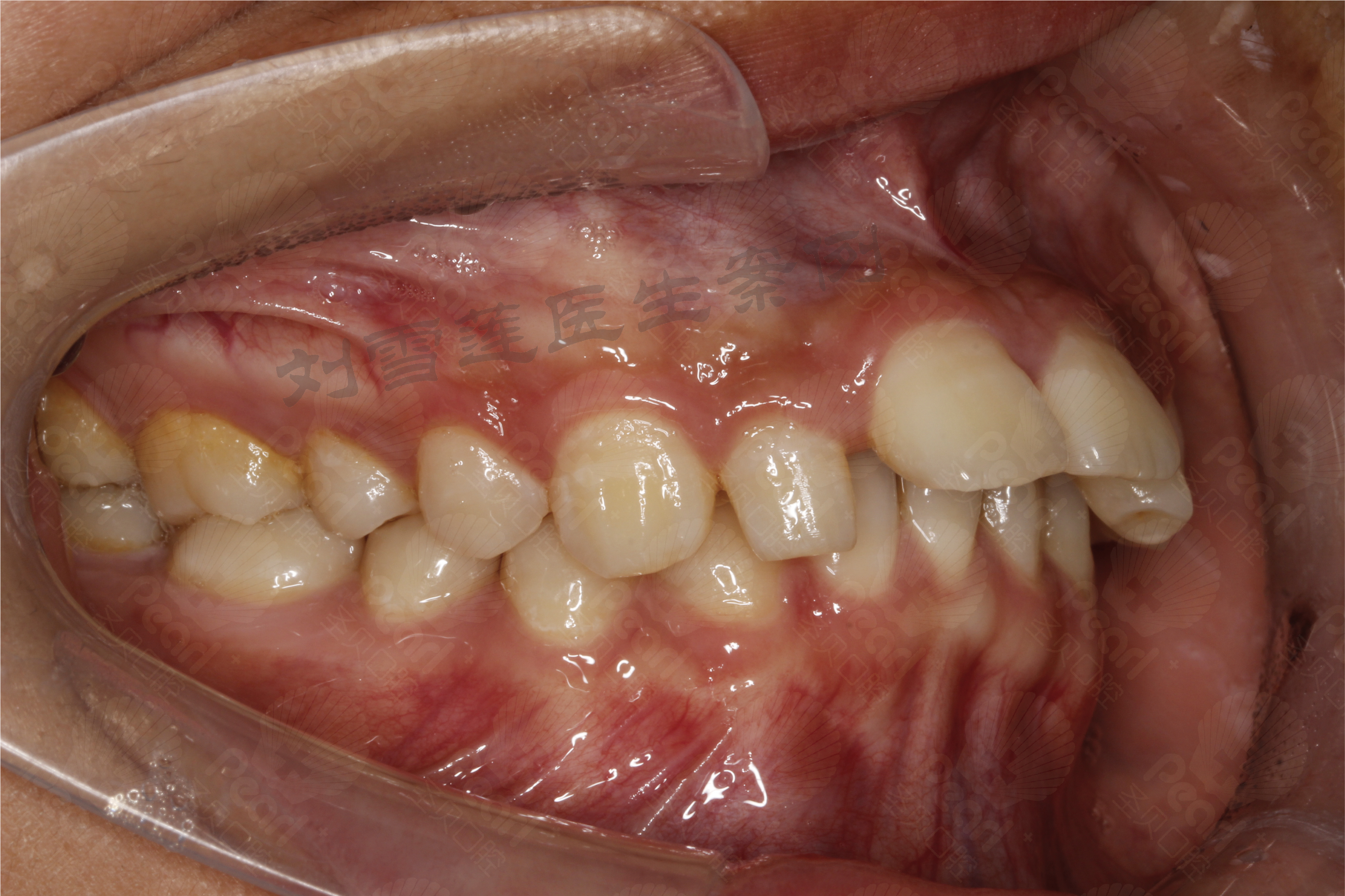 错位情况以及咬合关系二,口内牙齿照片侧面照片,帮助医生判断上下颌