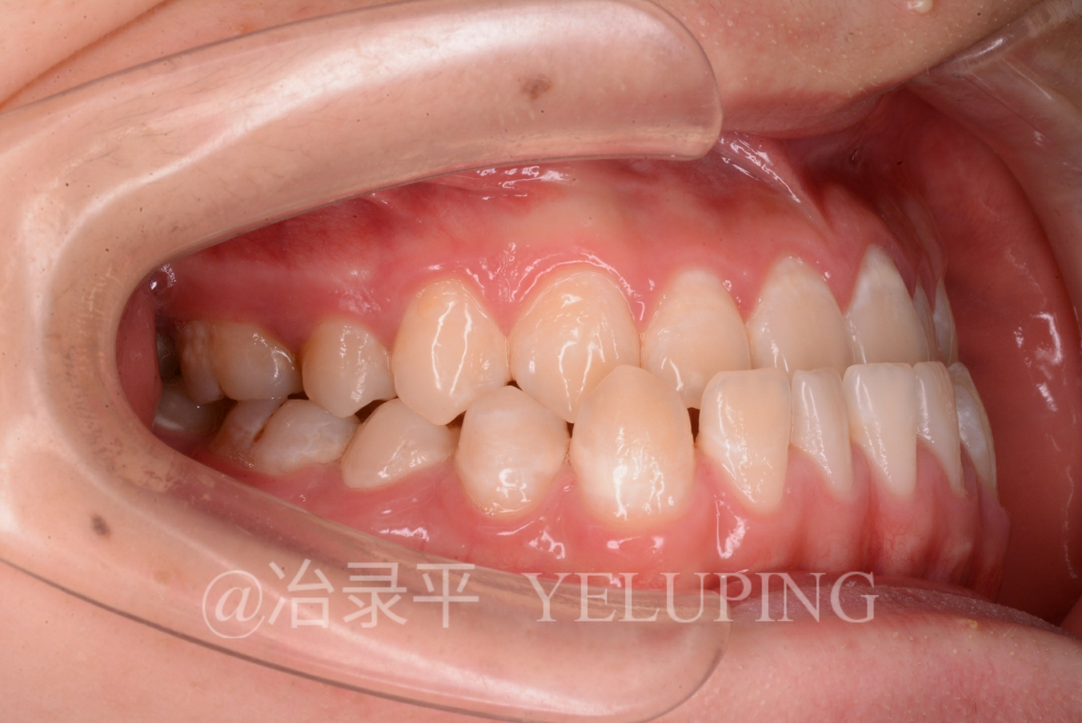 地包天形成中不容忽视舌系带过短的影响