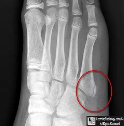 注意丨极易被误诊为骨折的21种结构