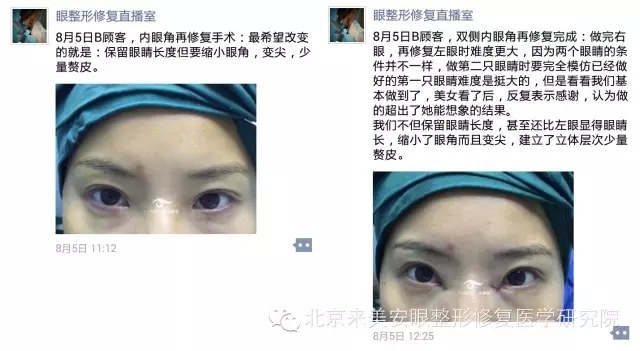 来美安15年8月5日b顾客内眼角修复术后5个月恢复过程及效果展示