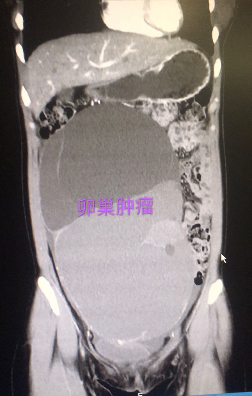 诊间日记巨大卵巢交界性囊腺瘤