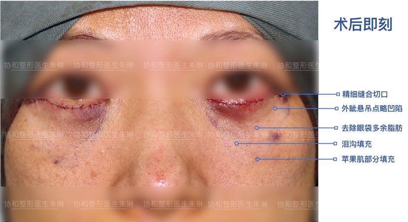 外切眼袋综合案例详解 附术后眼部抗衰小建议