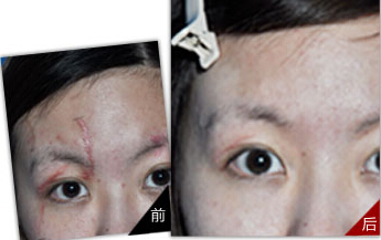 激光去疤后恢复的好吗 去疤后如何护理