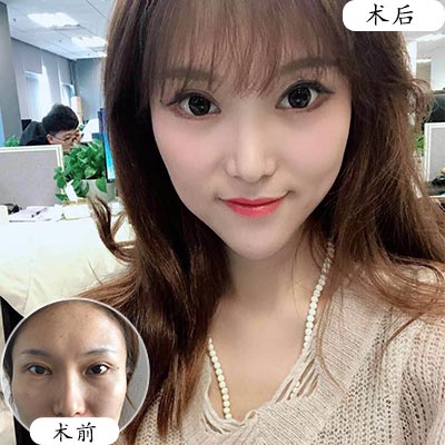 做完眼睑下至之后眼睛会衰老的更快吗