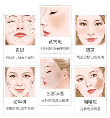 色斑真心让人自卑,该怎么祛斑呢?