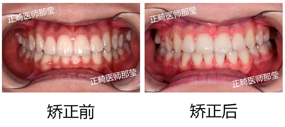 所以,不要以为只有牙齿不齐才需要矫正,深覆合和深覆盖也需要改善的.