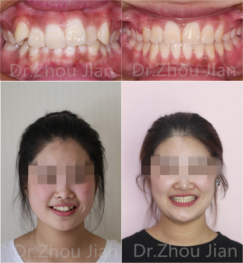 这个案例难度其实非常大,因为牙齿很直又内扣,但是骨头却突在外面