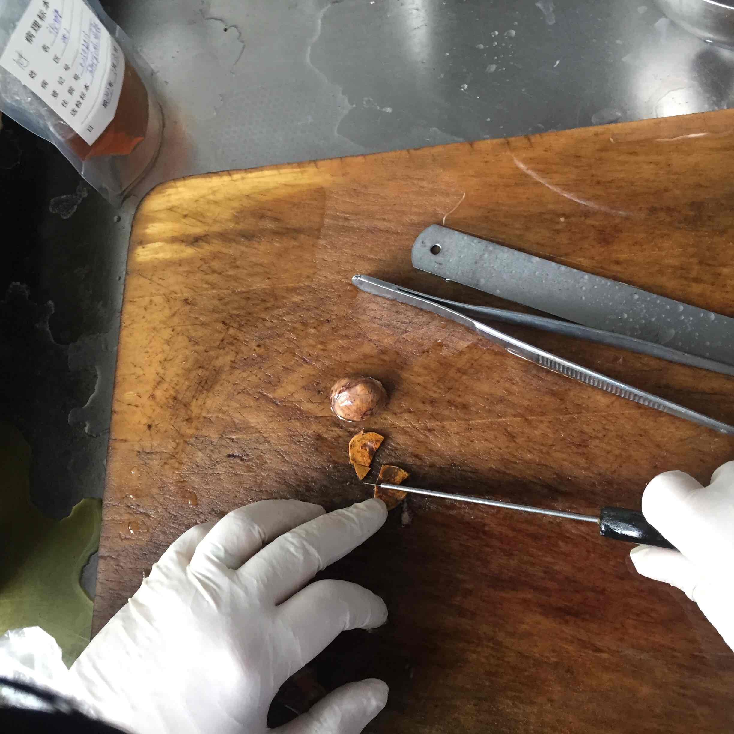 可恶的阴茎癌肾癌前列腺癌及肾上腺肿瘤