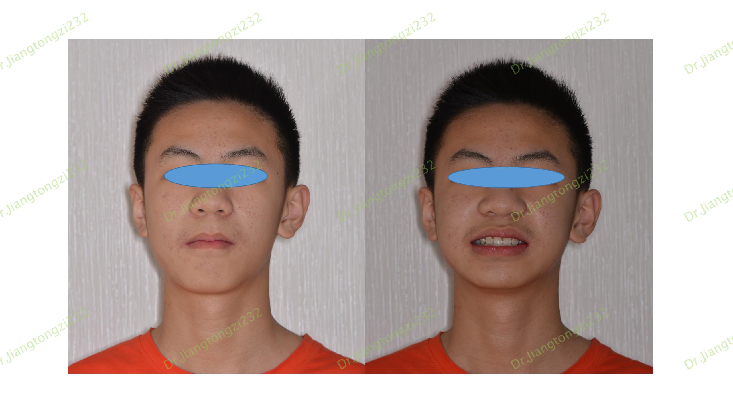 《正畸案例47:牙齿矫正后的牙面白斑》