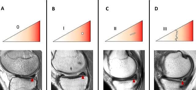 为什么半月板撕裂后,膝盖会"滋啦"响?该咋办,医生给您讲清楚
