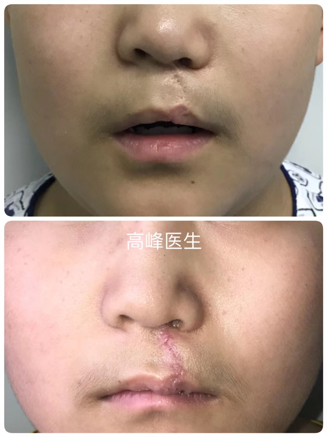 唇裂术后疤痕变化过程图片