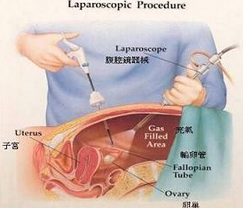 介入治疗:利用一根导管由腿部动脉穿刺进入,到达子宫两侧供血动脉