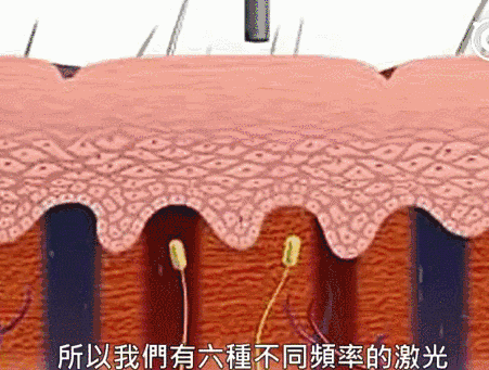 激光洗纹身会不会留疤?纹身后怎样做才能快速恢复?