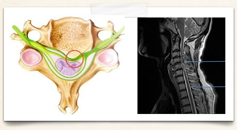 conditionsimg-myelopathy.jpg