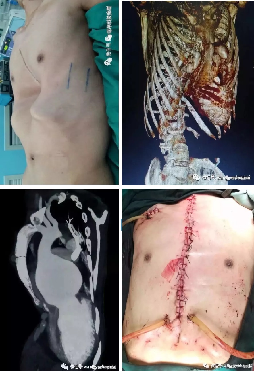 专治各种漏斗胸手术失败改良wang手术