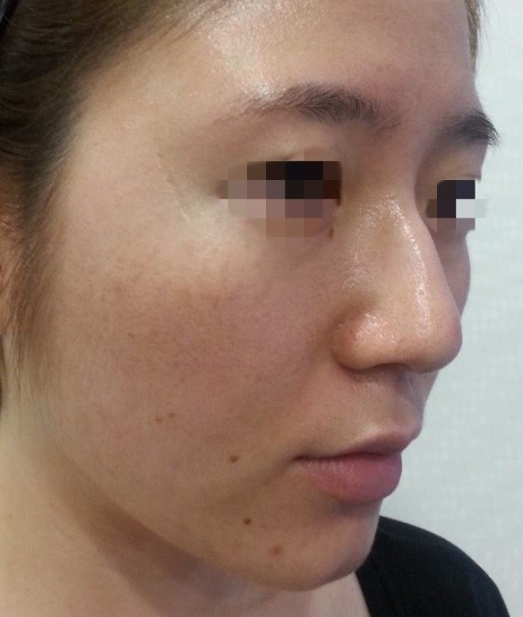 所有驼峰鼻情况都要磨骨吗?若是保留,你的脸真的有特色吗?