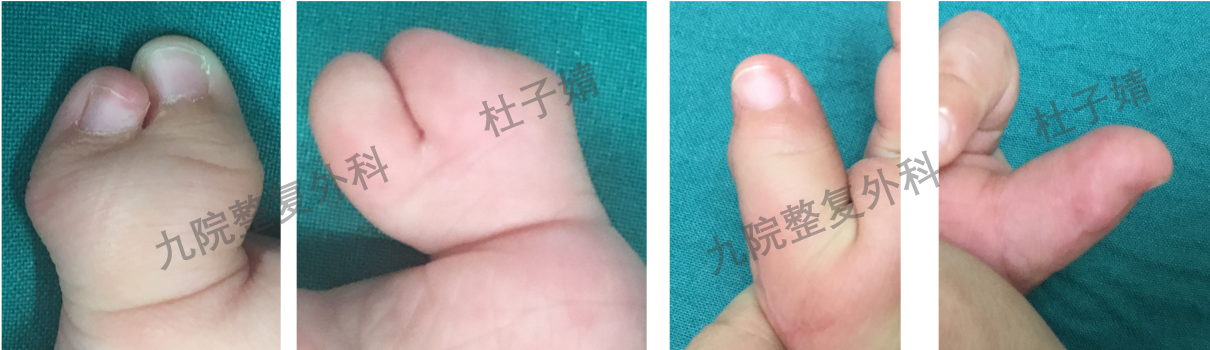 蟹钳状复拇畸形的治疗