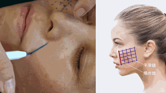 线雕提升:提上去30岁,放下来50岁!你还在等什么?