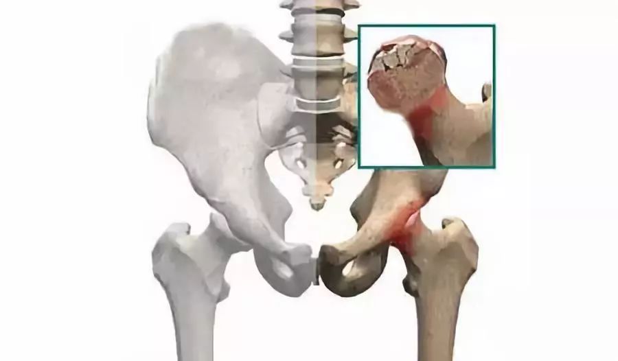 预测股骨头的塌陷方法