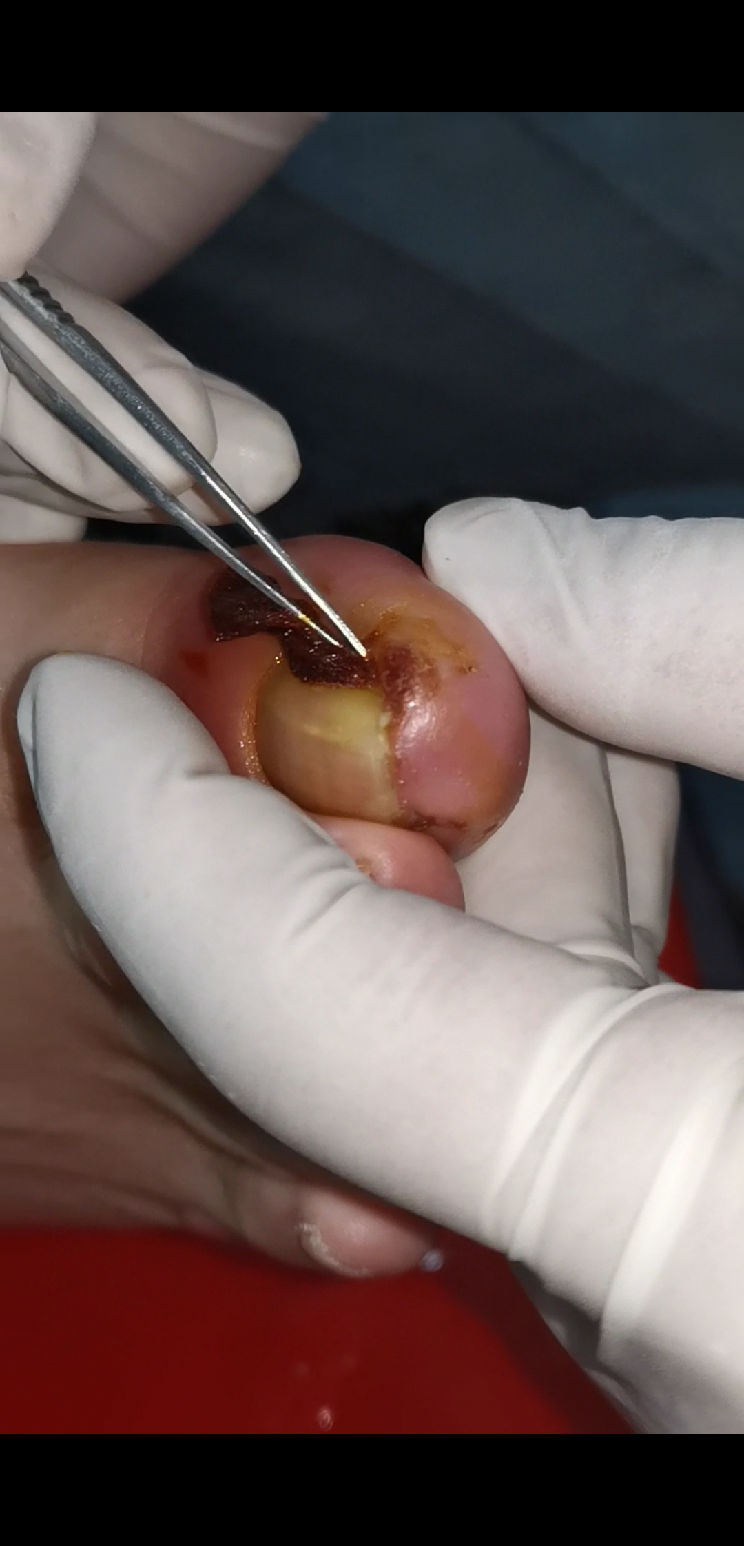 嵌甲甲沟炎的棉花填塞方法