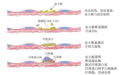 为什么要抗血小板治疗