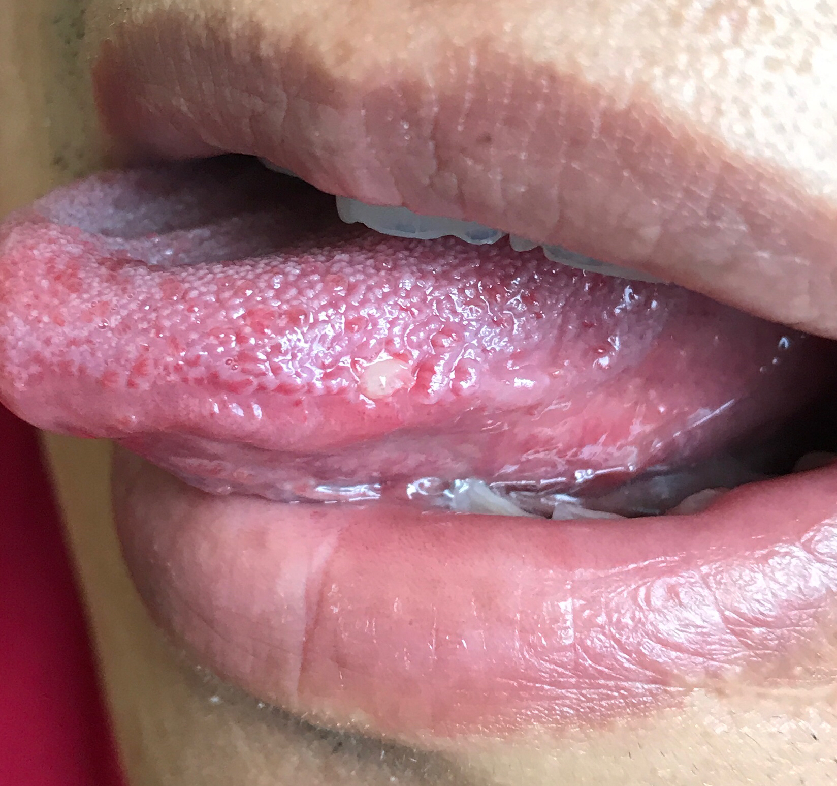 舌头hpv感染的症状图片