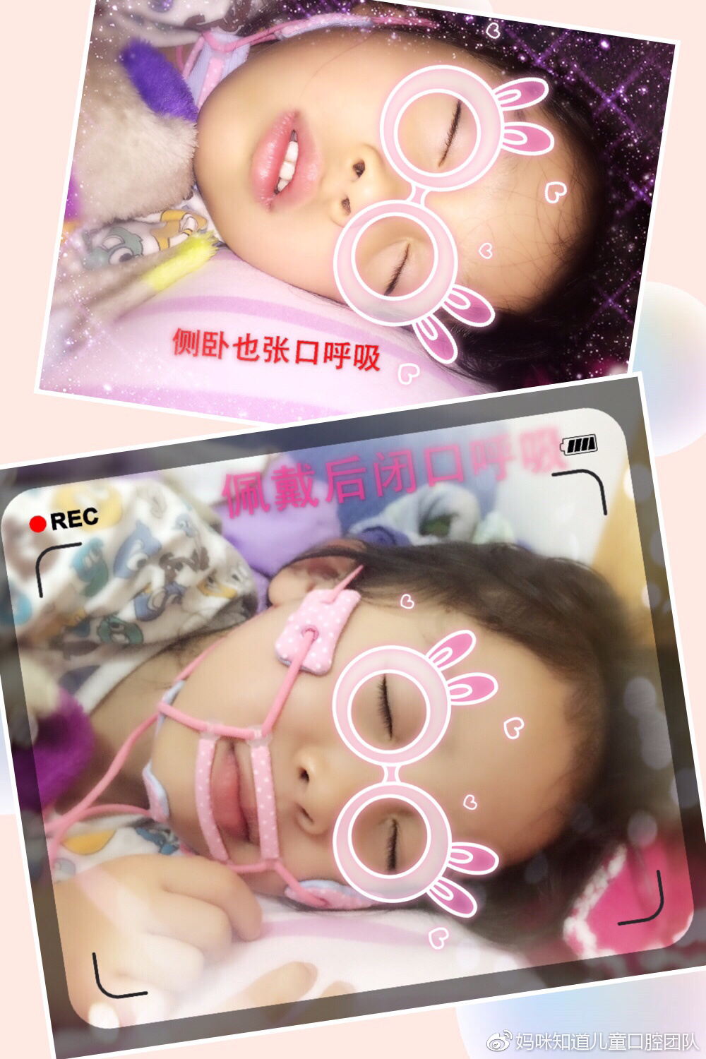 影响小孩颜值的"张口呼吸",原因及治疗方法有哪些呢?